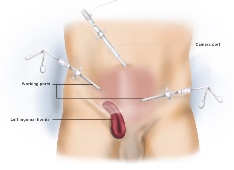 Open and Laparoscopic Treatment of Abdominal Wall Hernias دكتور