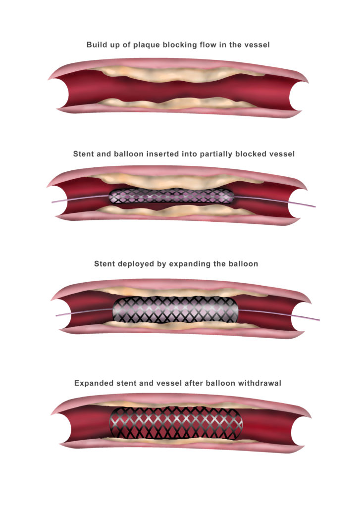 Endovascular Therapy For Peripheral Arterial Disease Dubai Dr