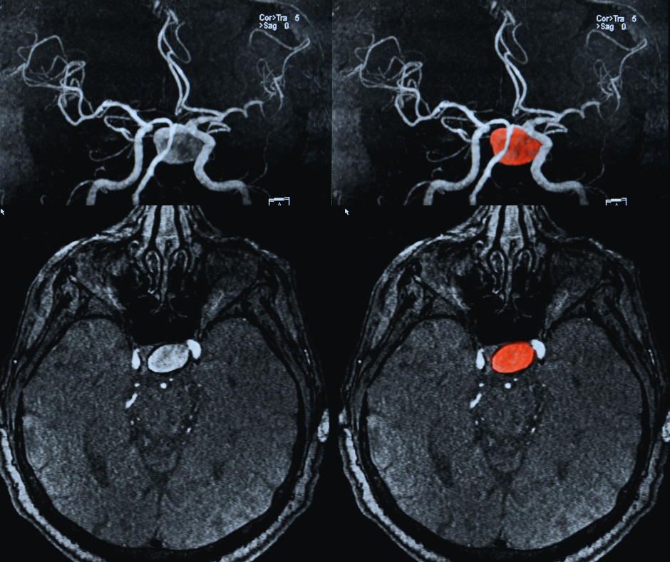 aortic aneurysm 