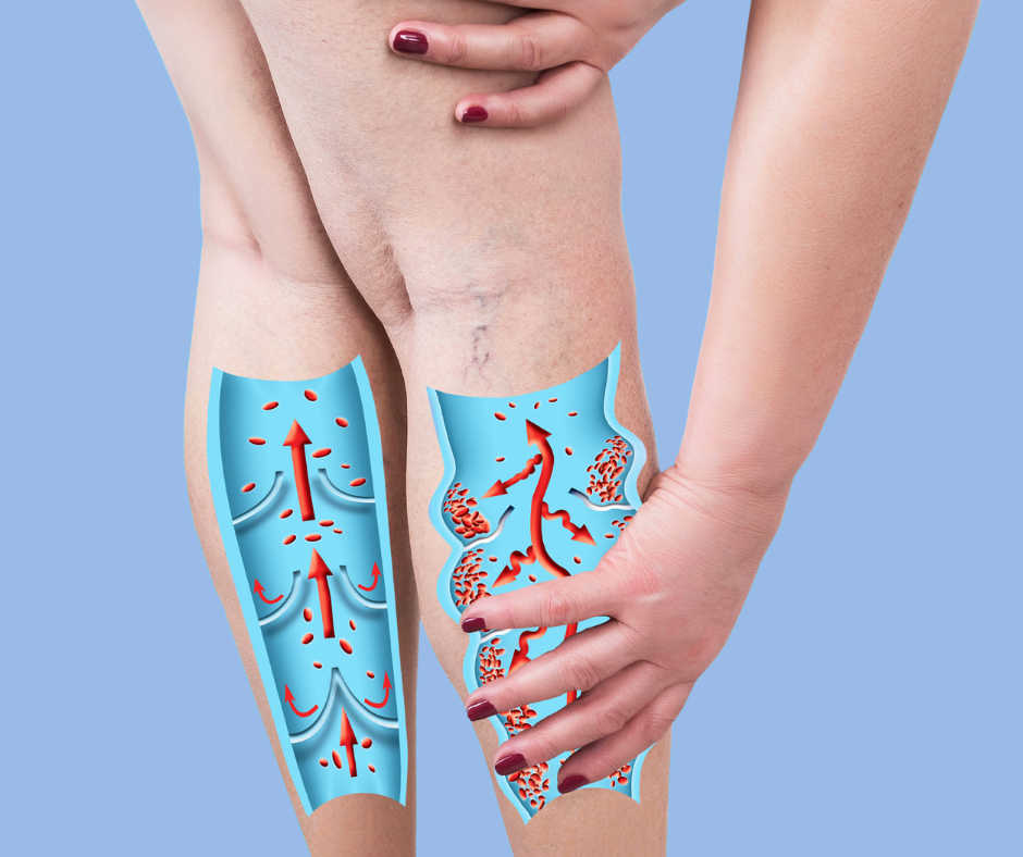 sclerotherapy for varicose veins