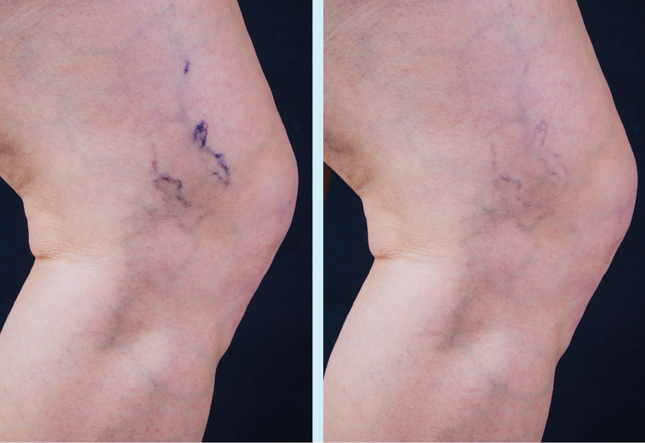 spider veins treatment