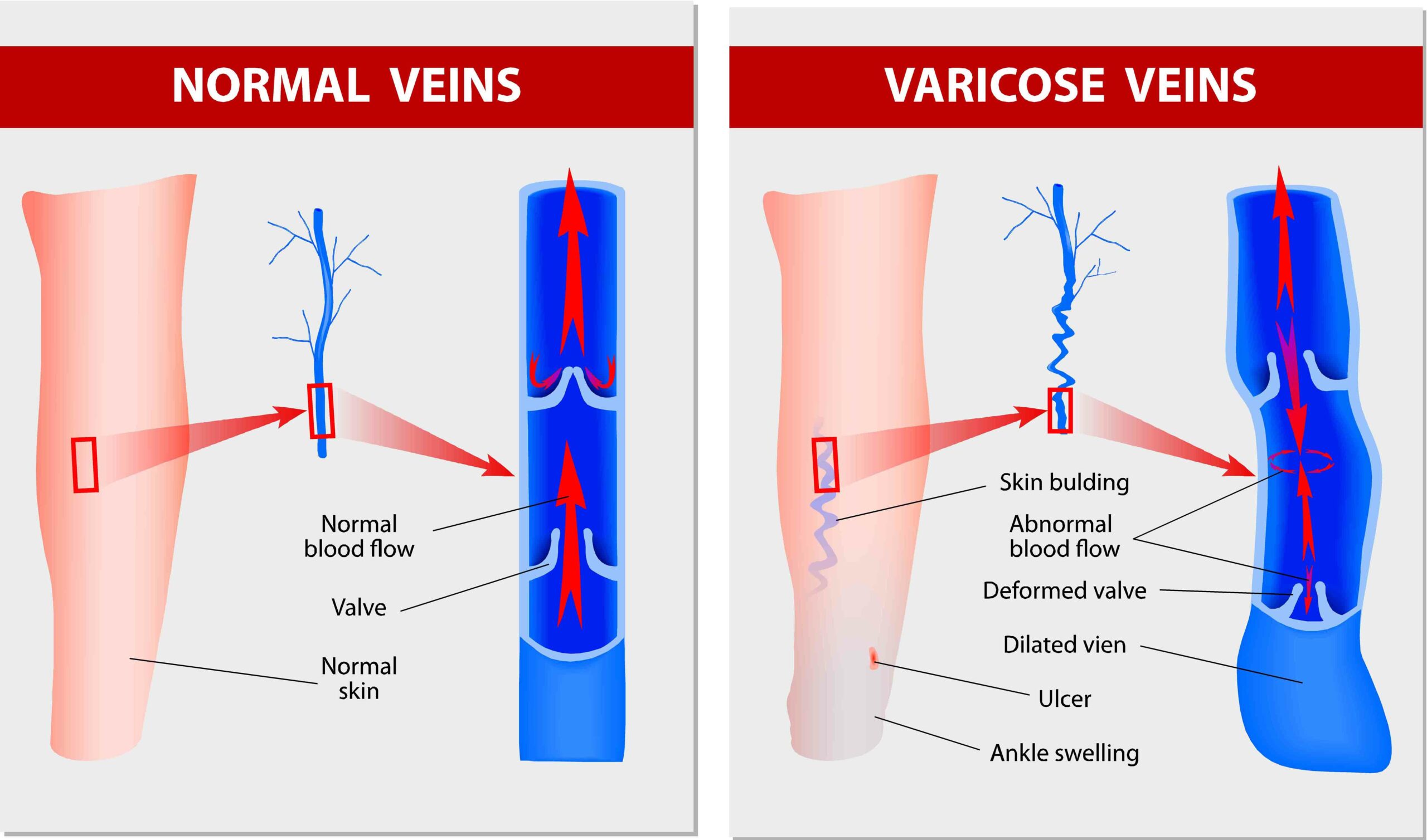 varicose veins