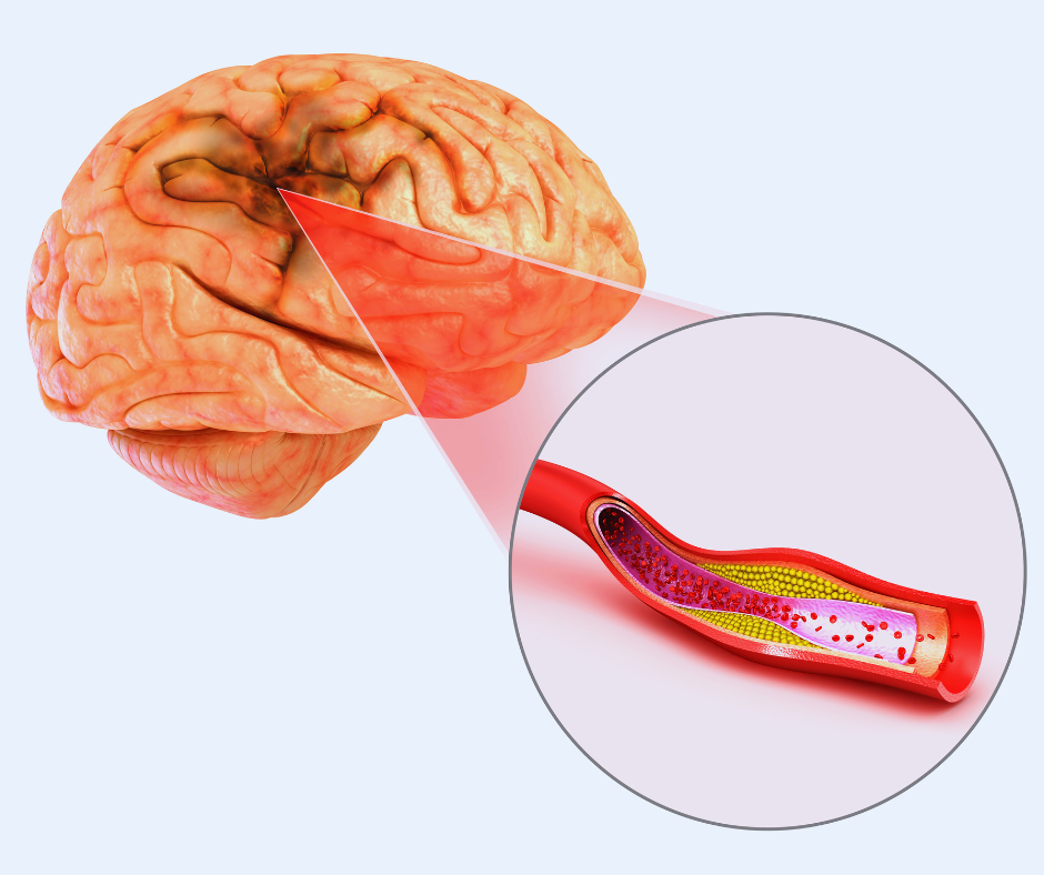 stroke treatment