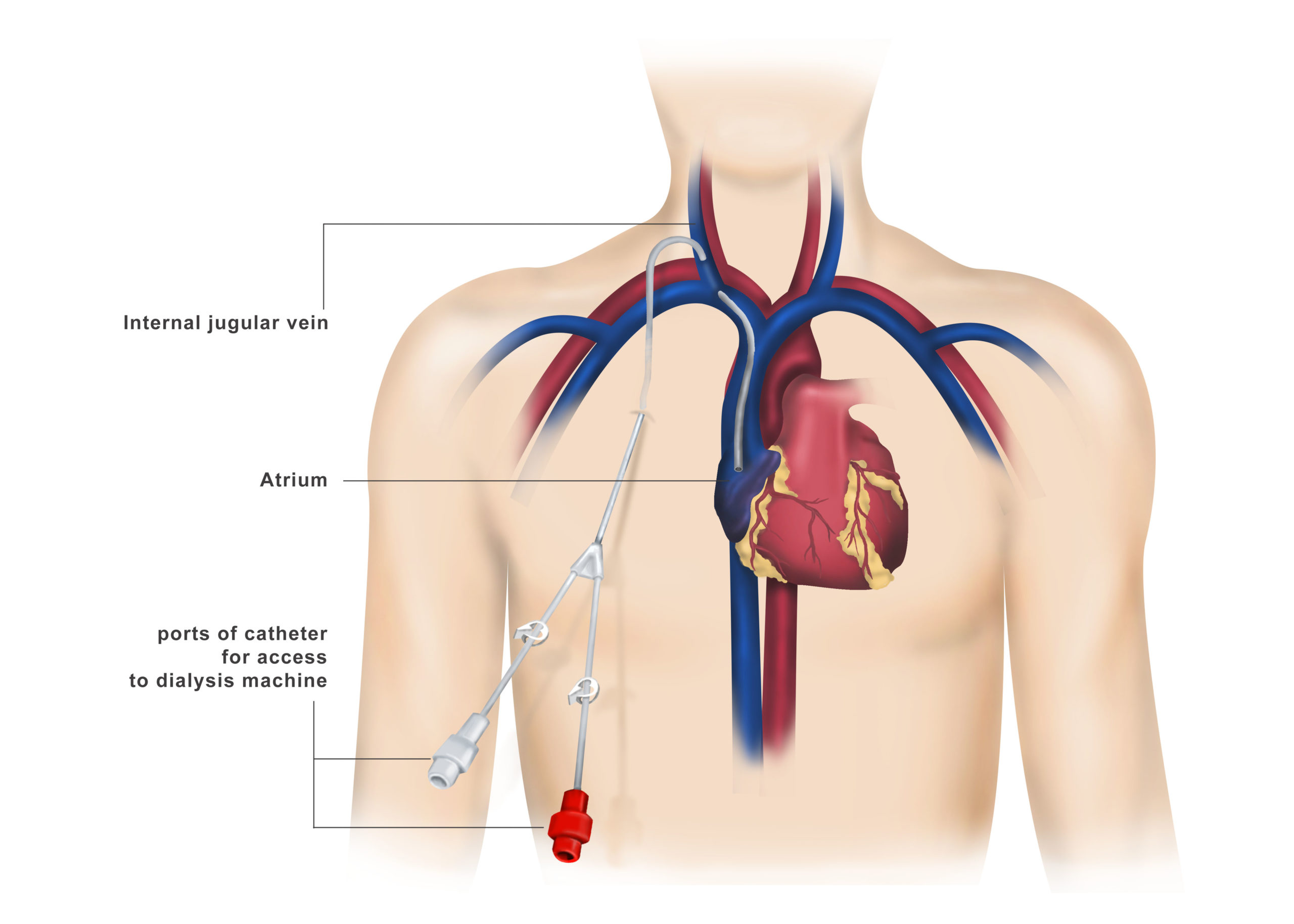 dialysis-access-surgery-dr-ahmed-farah-abdulrahman