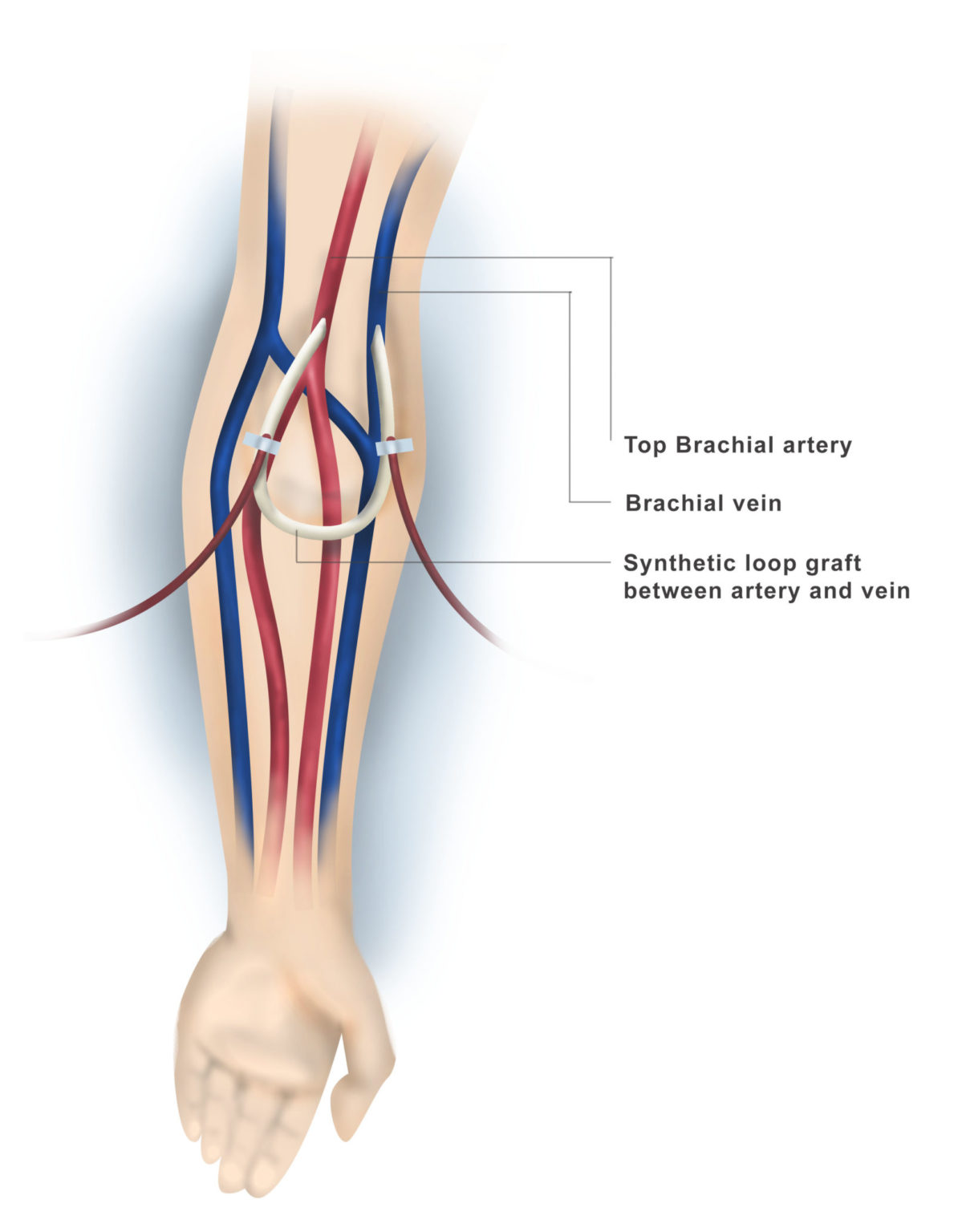 Creation Of Dialysis Fistula Graft And Placement Of Peritoneal 