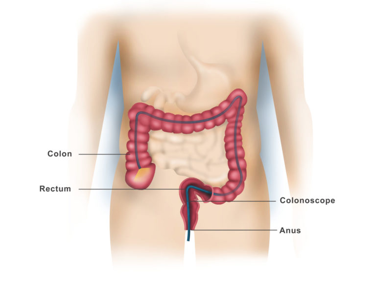 Upper and Lower Endoscopy - Dr. Ahmed Farah Abdulrahman