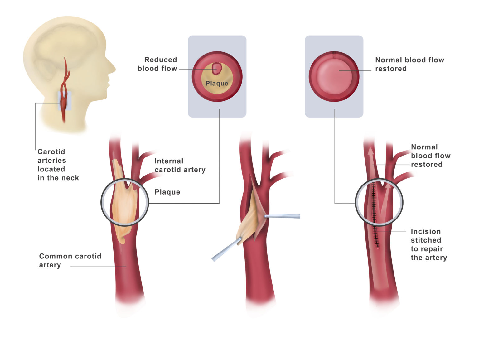 Carotid Disease Treatment Dr. Ahmed Farah Abdulrahman