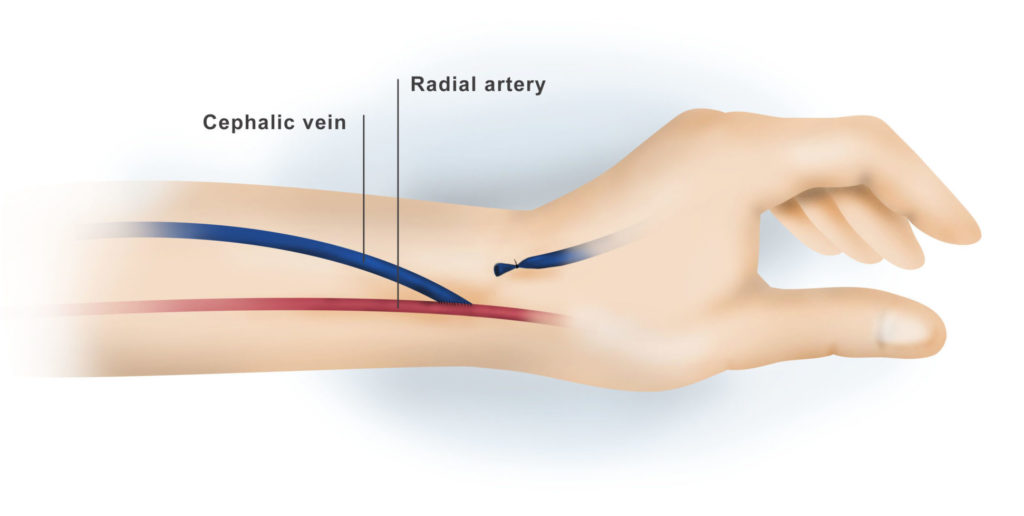 Dialysis Access Surgery Dr. Ahmed Farah Abdulrahman