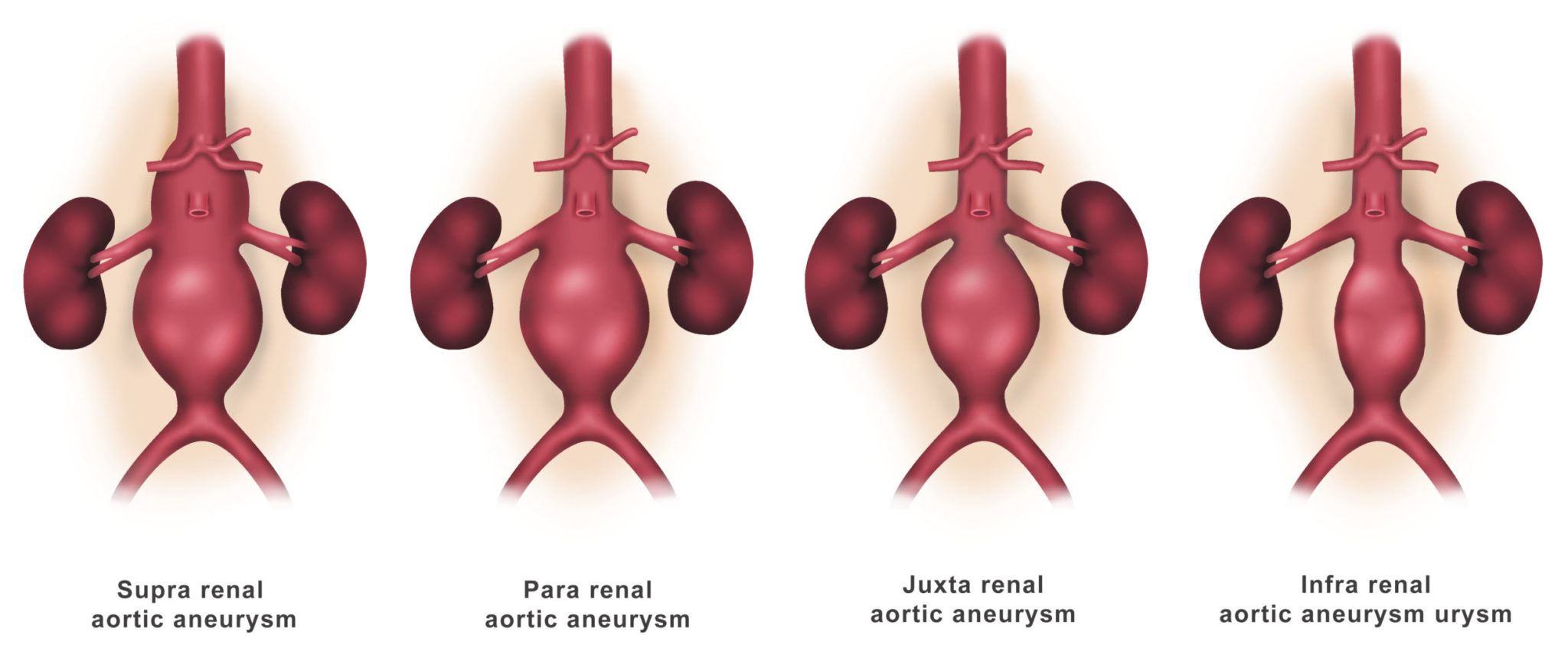 Aortic Disease Treatment Dr Ahmed Farah Abdulrahman 8660