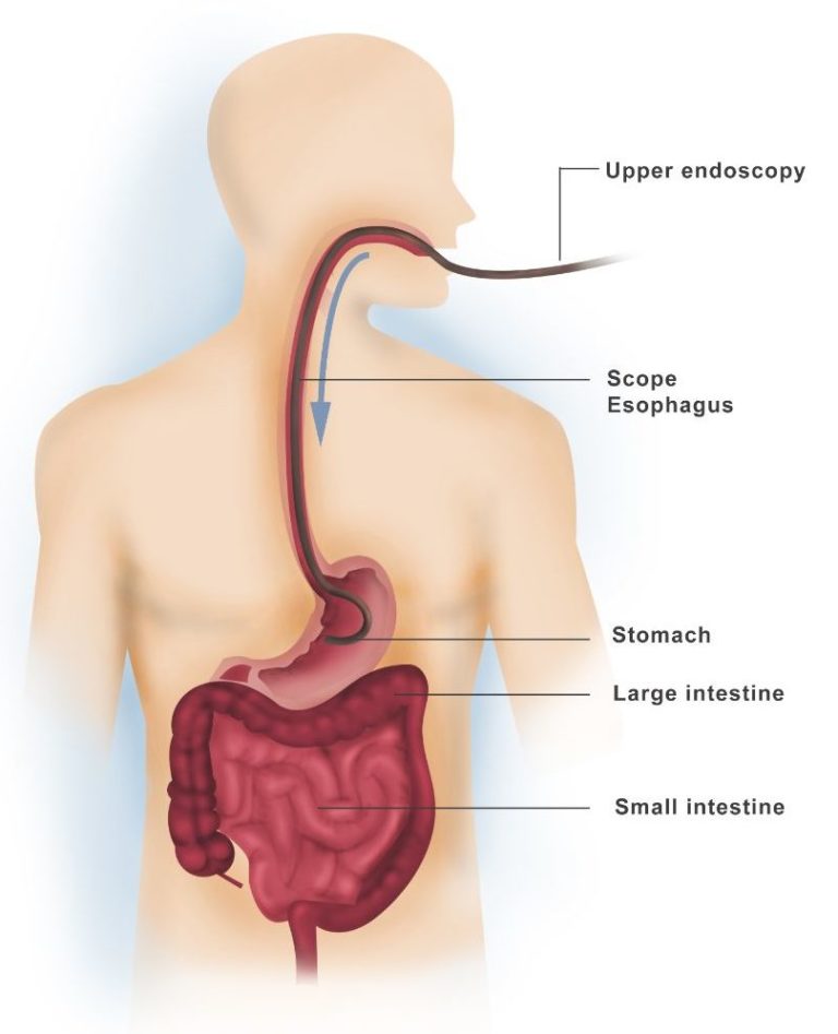 after effects of upper endoscopy