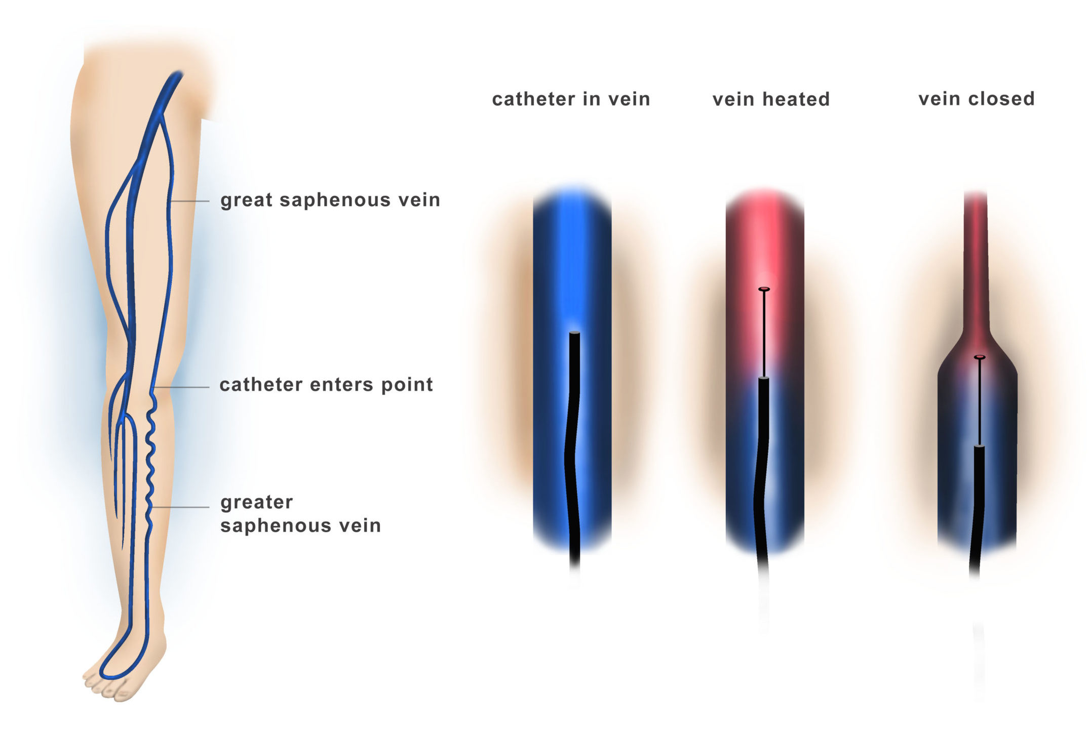 Saphenous Vein Ablation