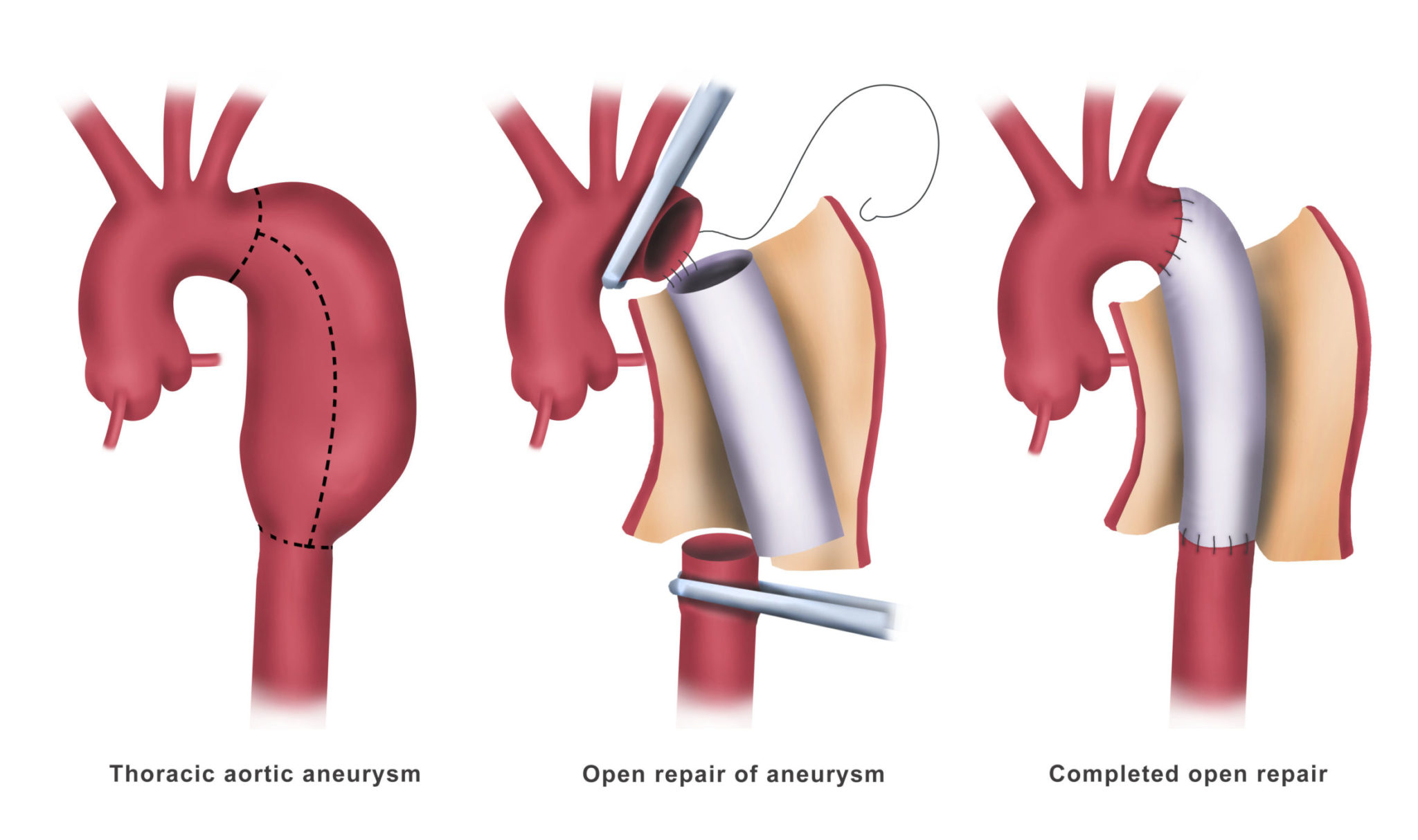 Aortic Arch To Abdominal Aorta