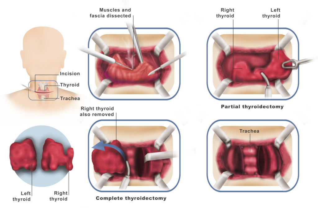 Thyroid And Parathyroid Surgery Dr Ahmed Farah Abdulrahman