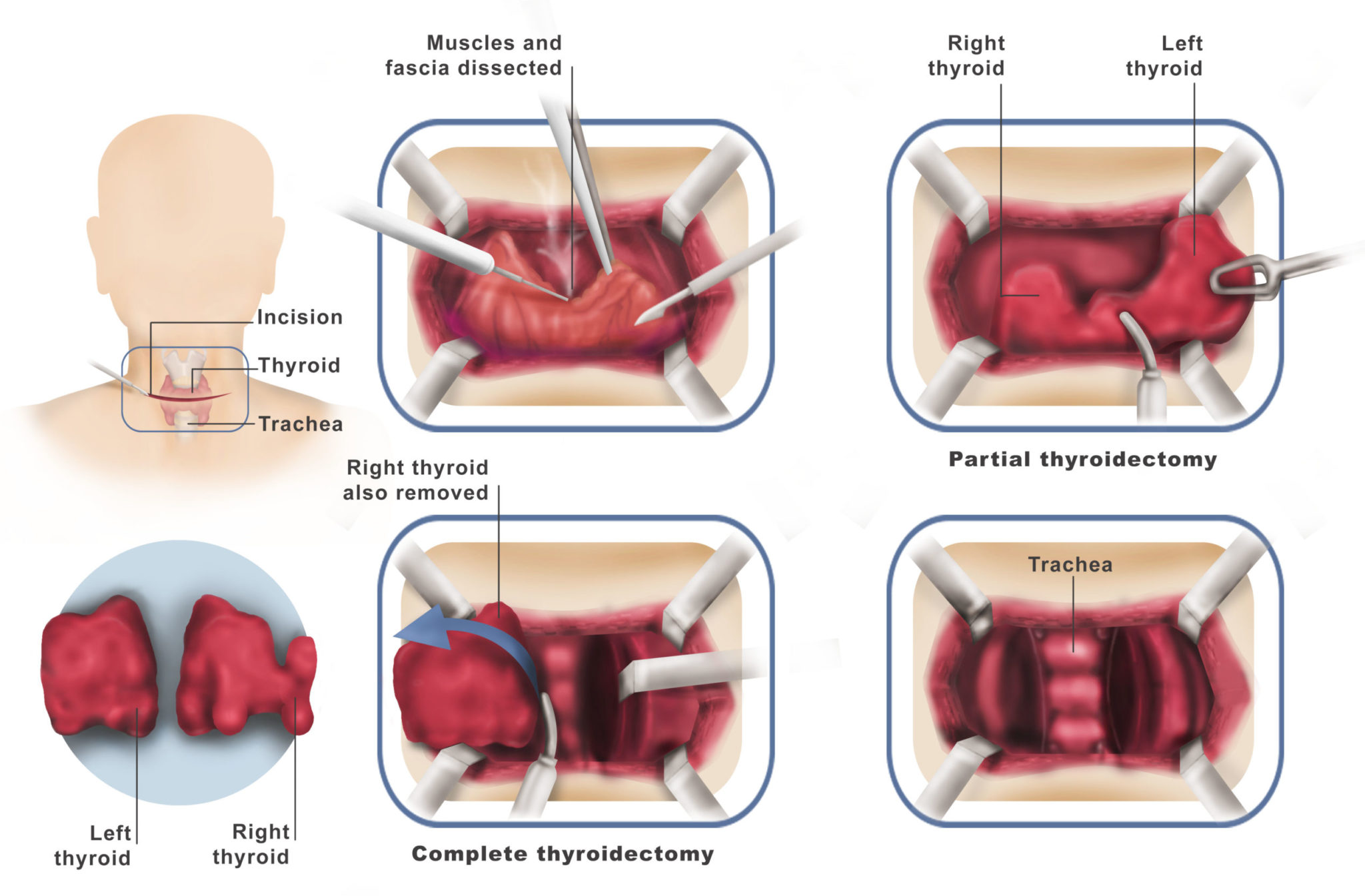 What To Expect After Thyroid Nodule Surgery