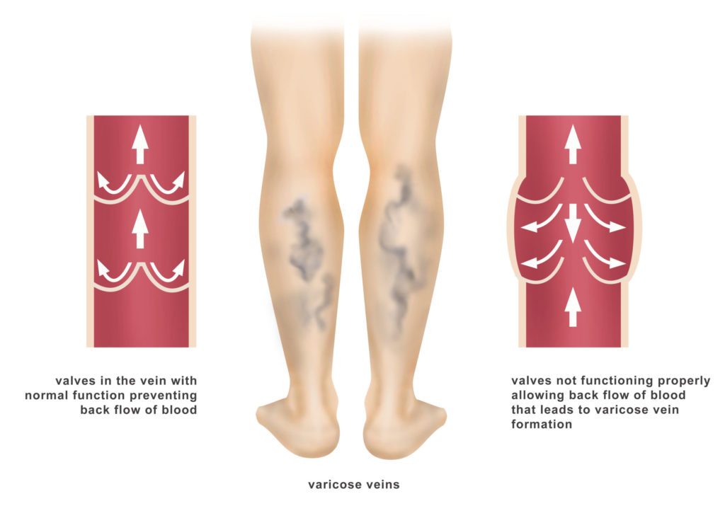 Varicose veins: Causes, Symptoms, Treatment, Diagnosis, and Prevention