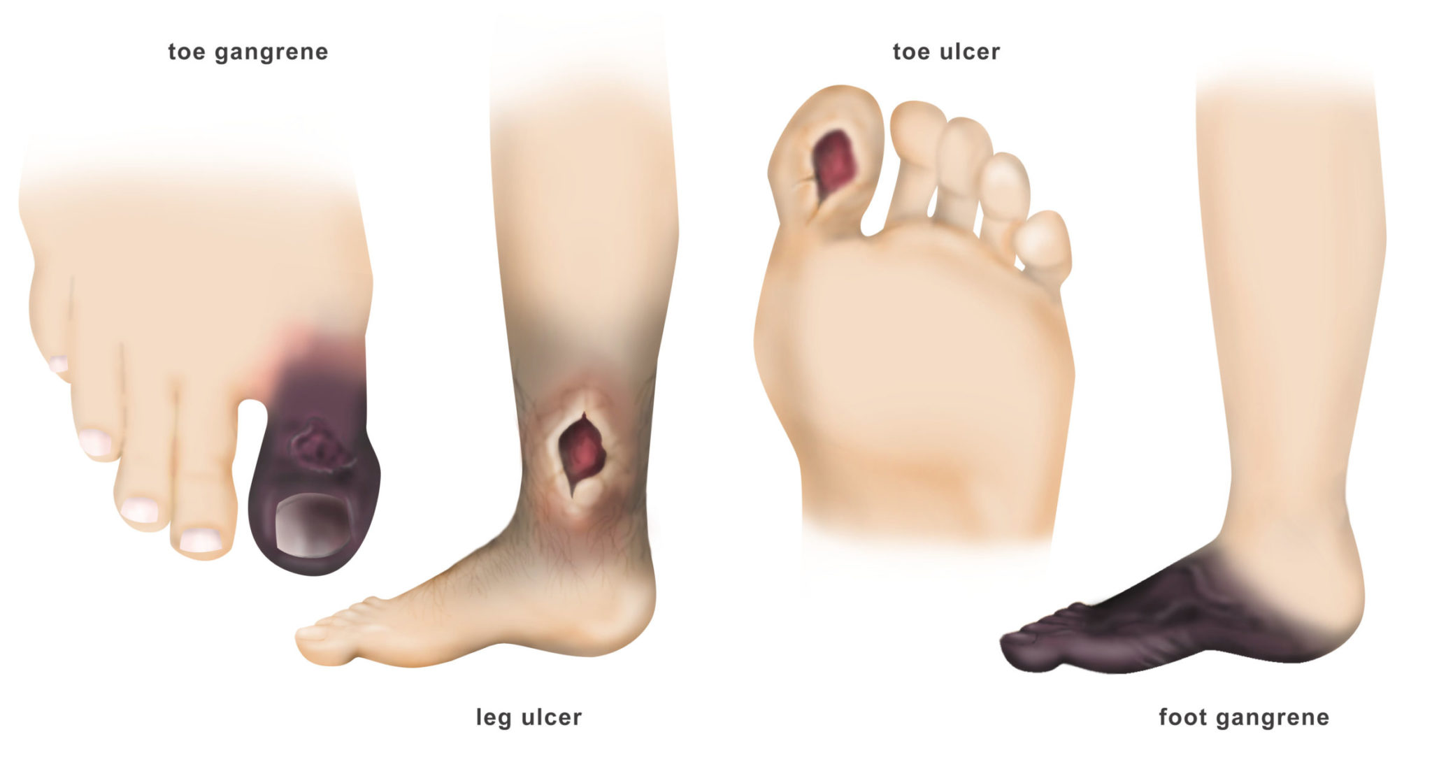 peripheral-arterial-disease-treatment-dr-ahmed-farah-abdulrahman