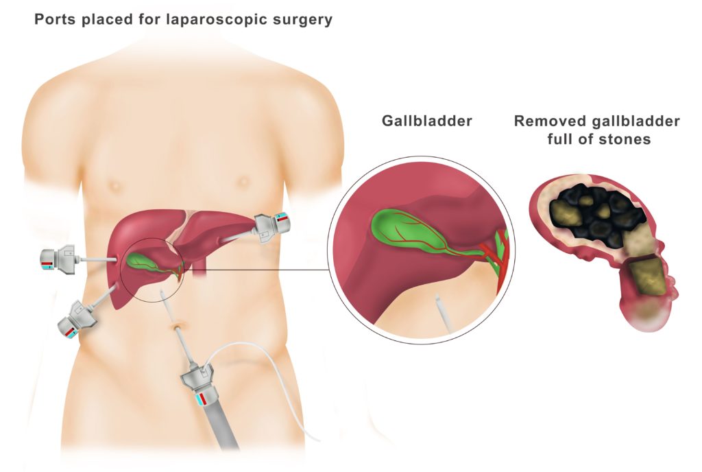 Open and Laparoscopic Gall Bladder Surgery Dr. Ahmed Farah Abdulrahman