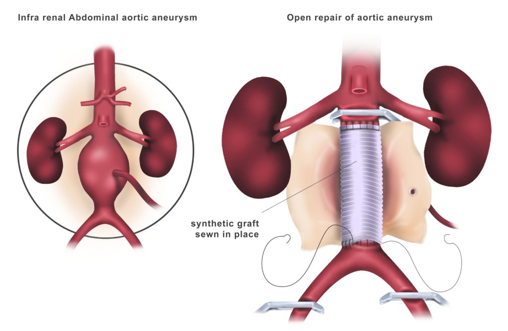 Open Aortic Surgery For Aneurysms Dubai Dr Ahmed Farah 1529