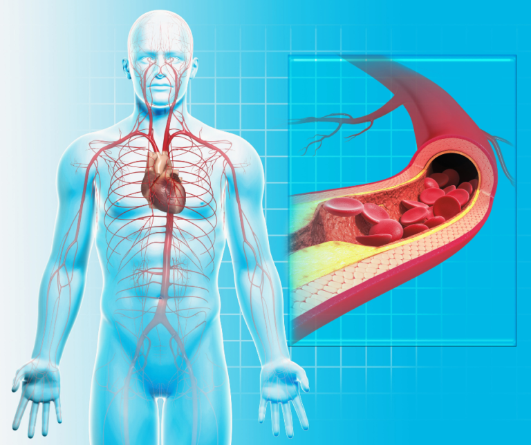 Peripheral Arterial Disease: Symptoms, Diagnosis, and Treatment