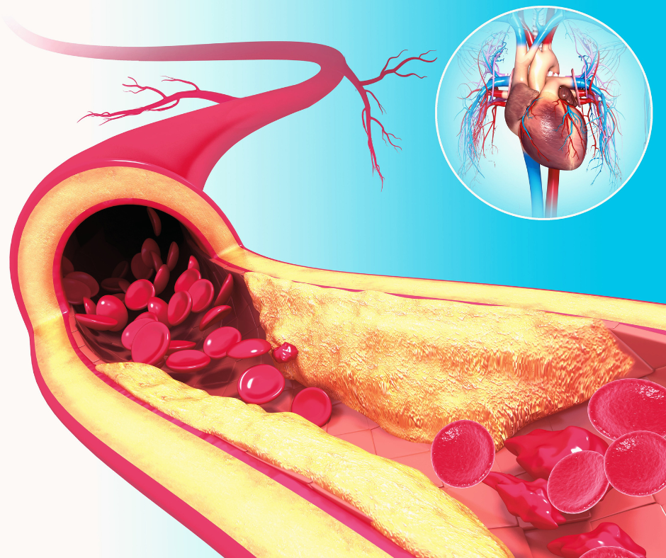 Peripheral Arterial Disease: Symptoms, Diagnosis, And Treatment