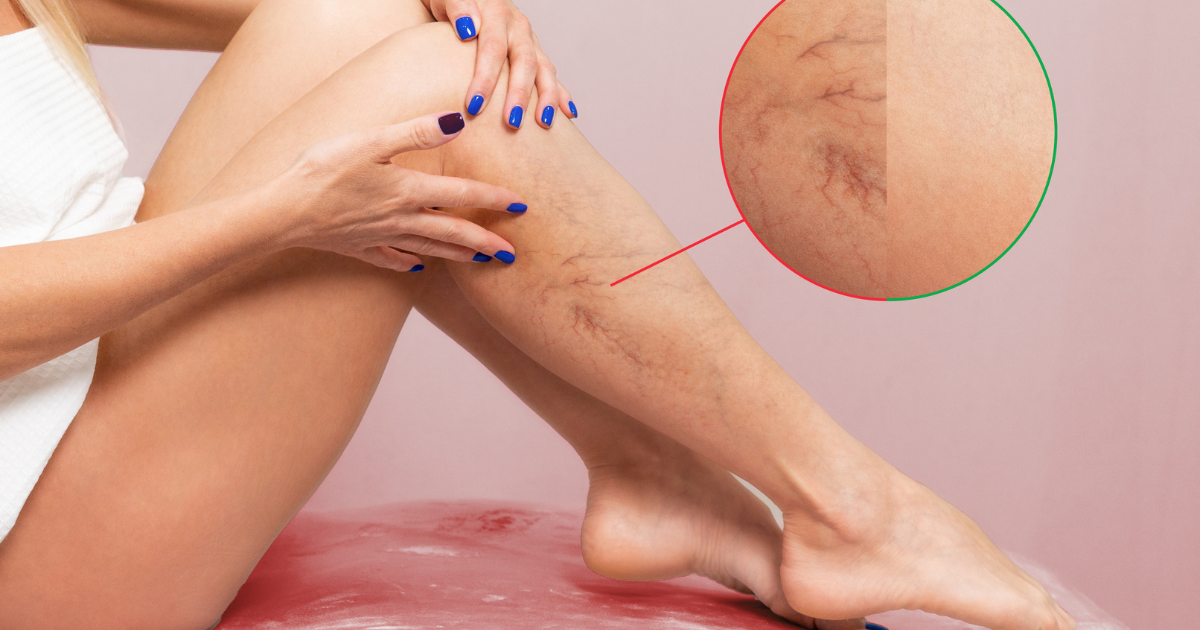 Graphic illustration showing the anatomy of varicose veins, highlighting causes and symptoms.