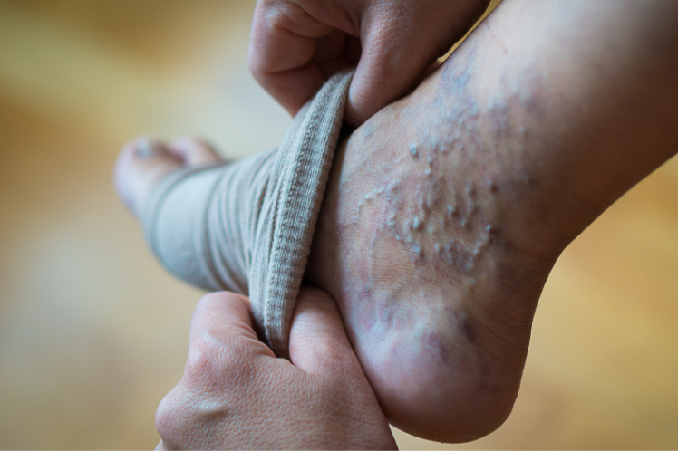 Close-up view of a person's hands wrapping a compression bandage around a leg with visible signs of varicose veins and skin issues, emphasizing the medical use of compression therapy for vein health.