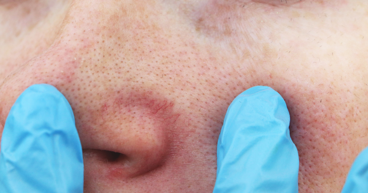 Diagnosing face spider veins