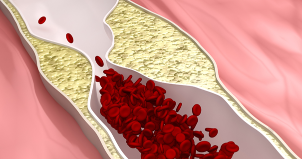 The image shows a detailed cross-section of a carotid artery with significant plaque build-up, indicating atherosclerosis. The narrowed artery, located in the neck, impacts blood flow and can affect the common carotid artery as well as the external carotid artery branches. 