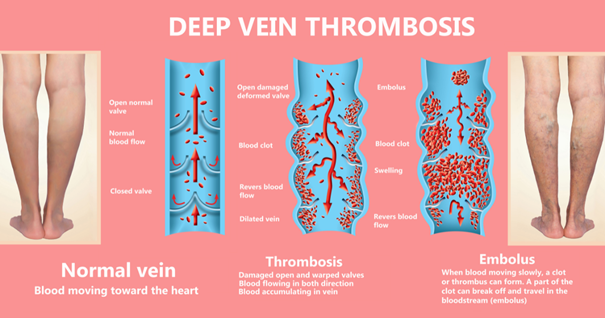 The infographic highlights early stage blood clot in leg symptoms, blood clot treatment, and the potential for brain blood clot symptoms. The diagram includes images of legs, demonstrating normal and affected veins, and depicts blood clots obstructing blood flow, leading to swelling and reversed blood flow. The embolus section shows how clots can travel through the bloodstream.