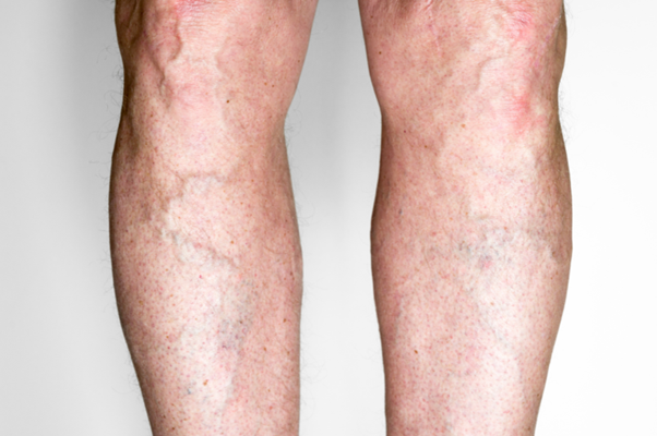 Image showing visible varicose veins on the legs, illustrating the need for varicose veins treatment Dubai. Sclerotherapy Dubai offers an effective, minimally invasive solution.
