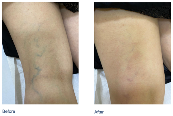 Before and after images showing the results of varicose veins treatment Dubai. This is the result of sclerotherapy Dubai.