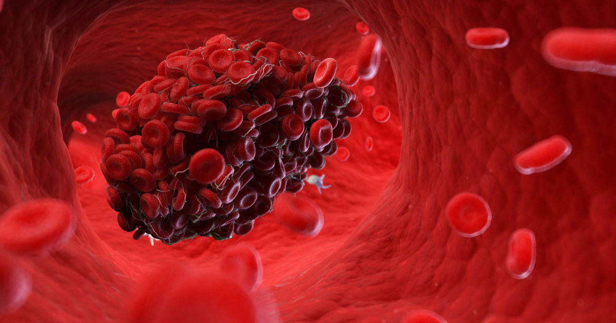 Educational illustration of a blood clot within a blood vessel